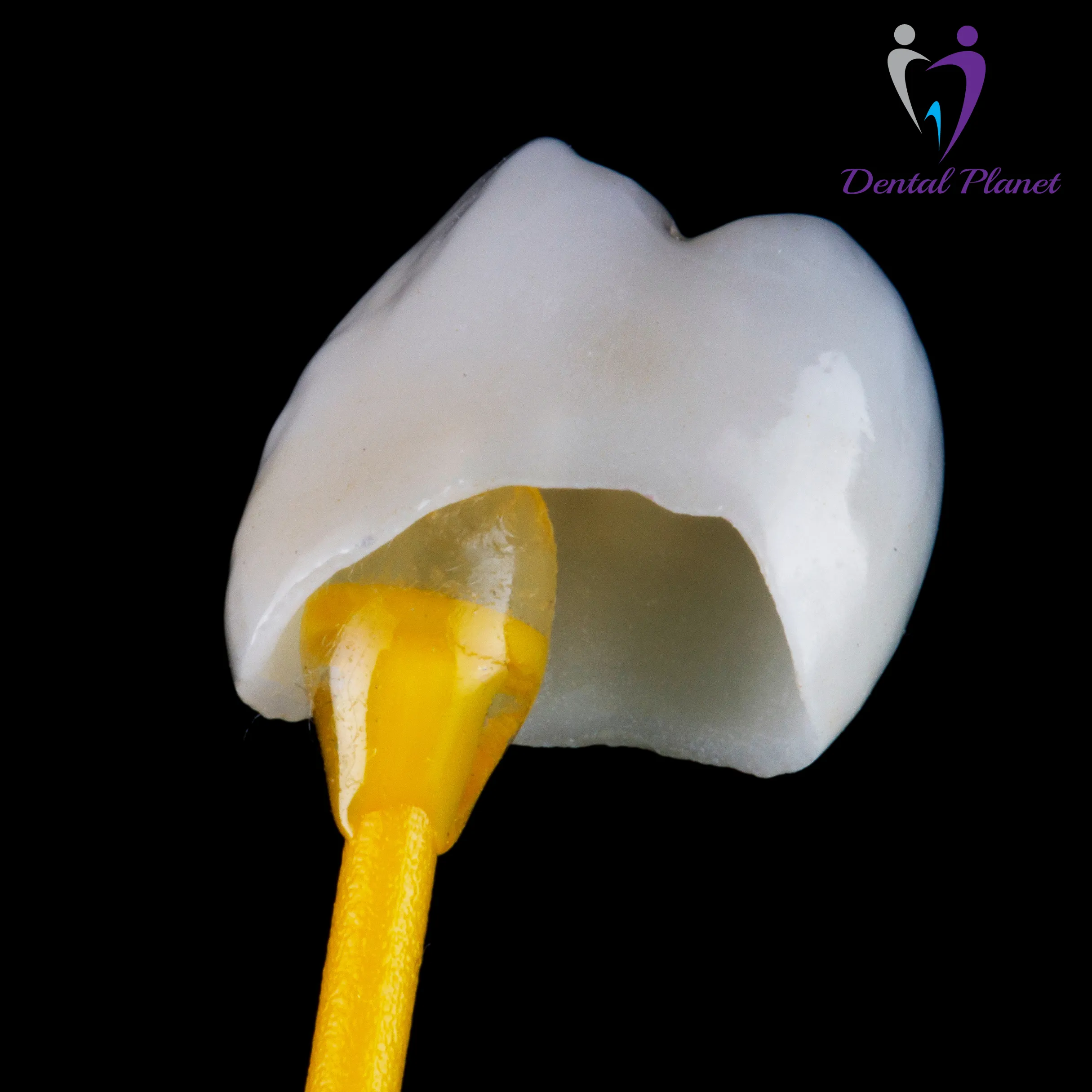 Dental Crown Procedure at Dental Planet