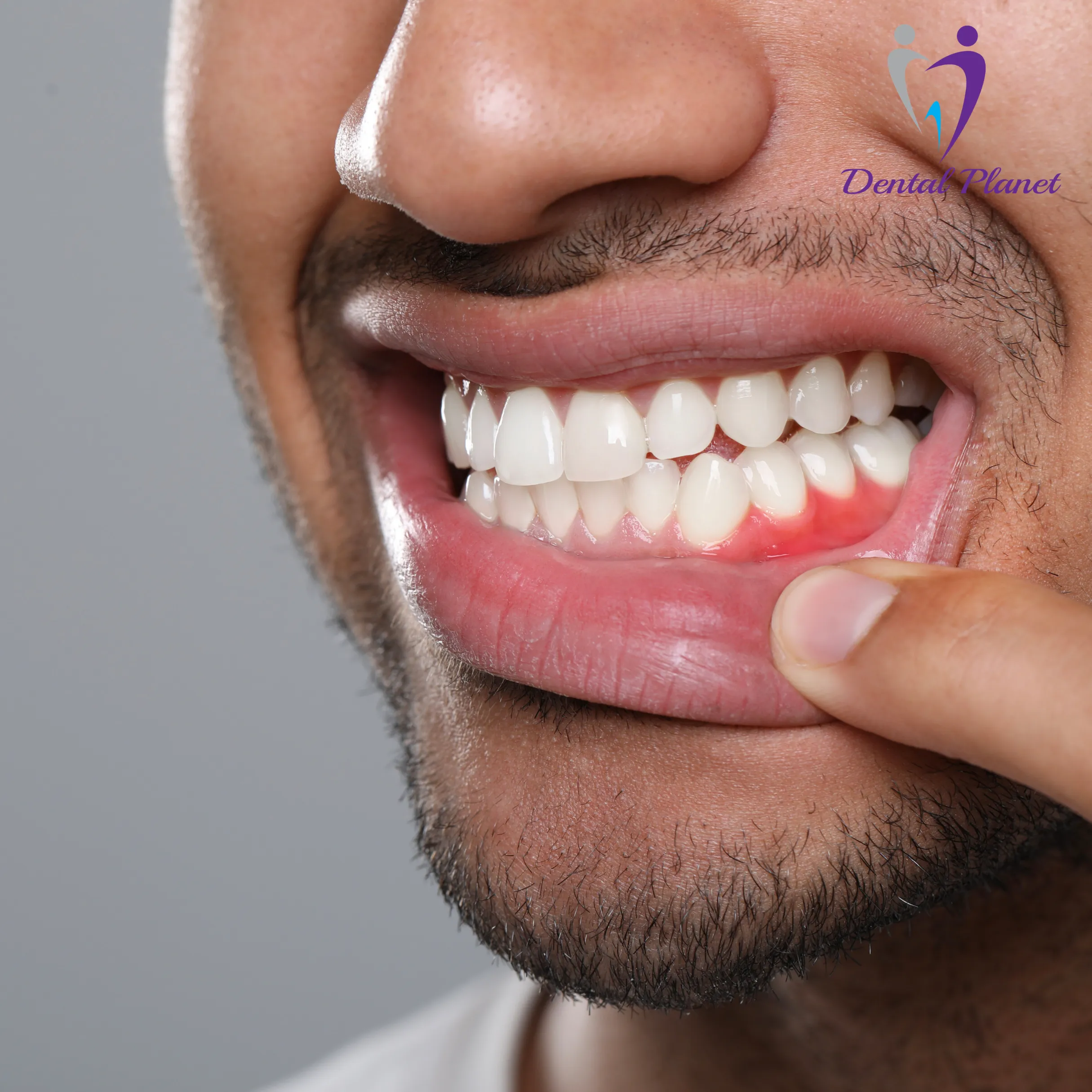 Periodontal and Implant Maintenance at Dental Planet Mysore