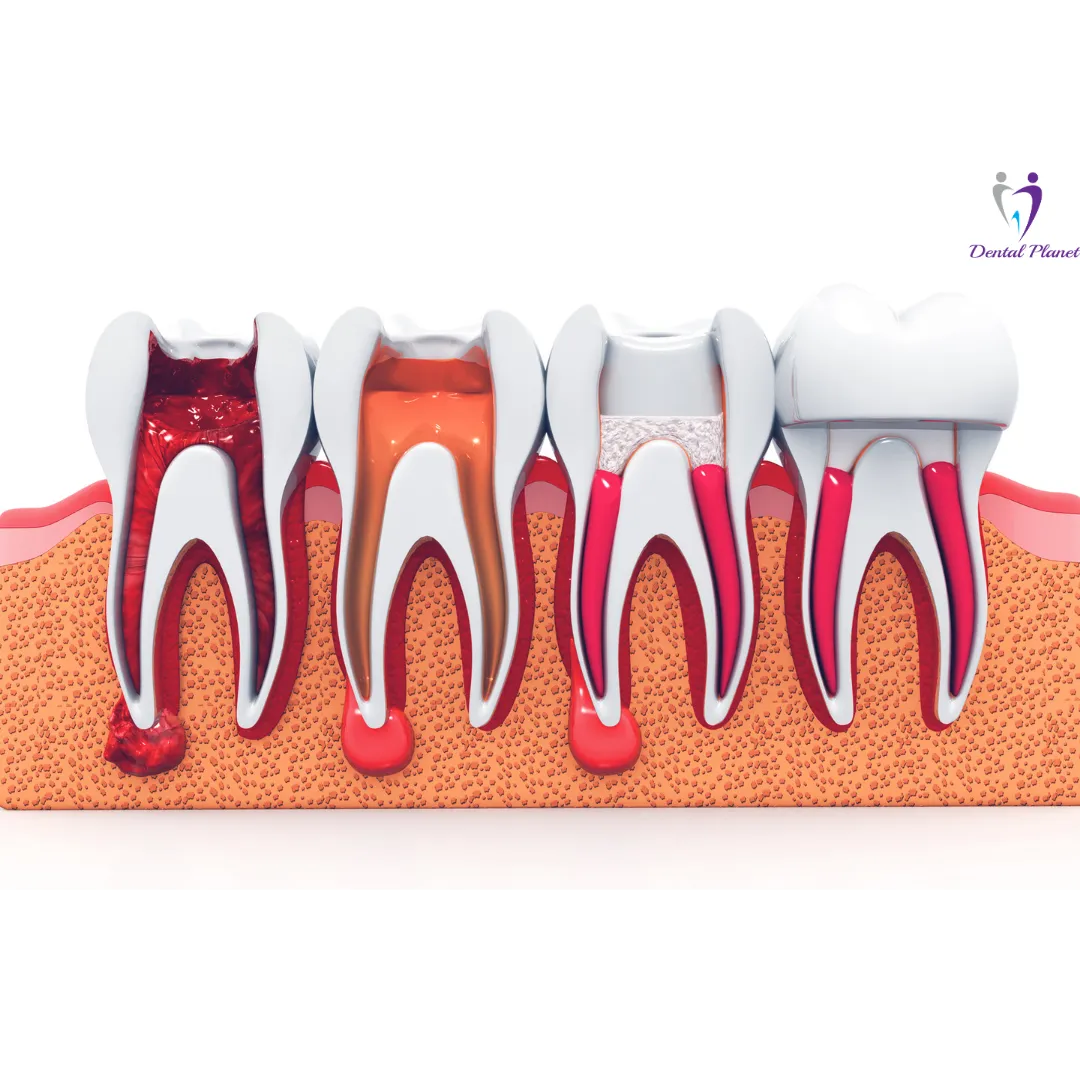 Root Canal Treatment
