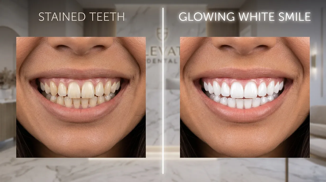 Teeth Whitening